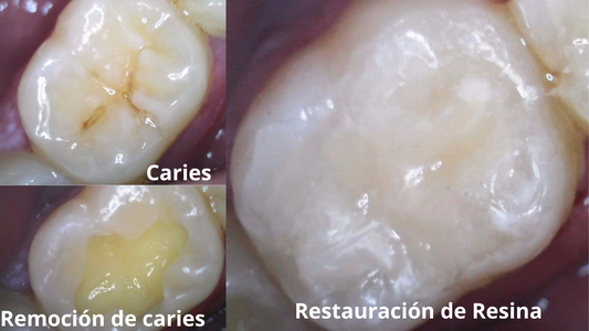 Calzas Dentales