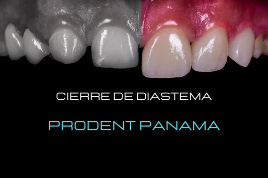 Cierre de Diastema