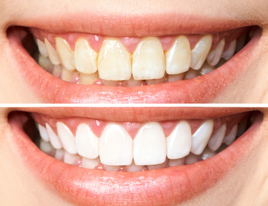 Blanqueamiento Dental