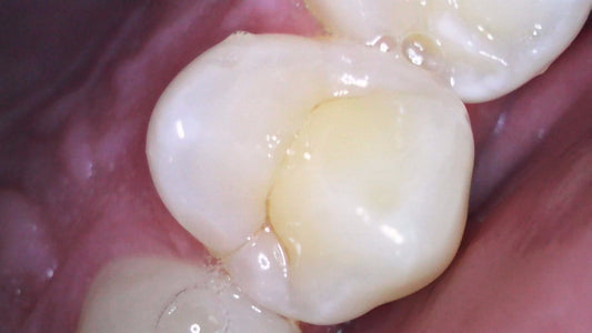 Calzas Dentales con Anestesia Digital sin Dolor