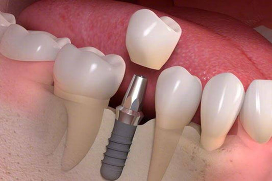 Implantes Dentales