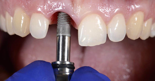 Implantes Dentales