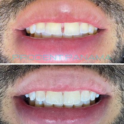 Cierre de Diastema