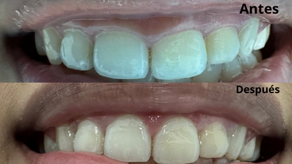 Recorte de Encías (Gingivectomía)