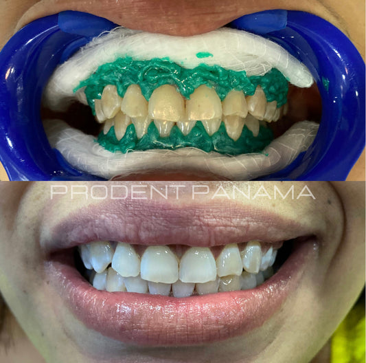 Blanqueamiento + Limpieza dental