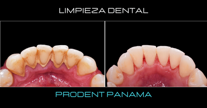 Limpieza Dental